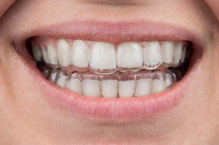 Close-up of a caucasian woman smiling with aligners on her teeth. Macro.