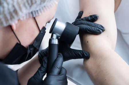 A dermatologist examines a patients mole through a dermatoscope.