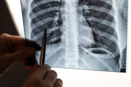 Doctor showing x-ray of patients lungs.