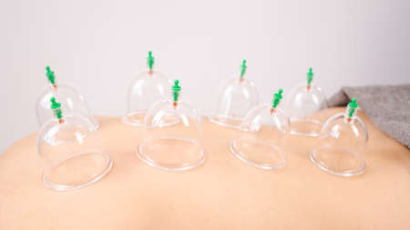 Female massage therapist uses vacuum cans on the patients back.の写真素材