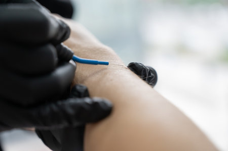 Dermatologist removes a mole on a patients arm using an electrocoagulator.