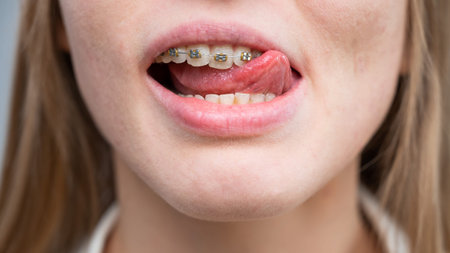 Close-up of a young womans smile with metal braces on her teeth. Correction of bite.