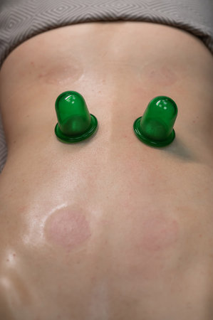 A woman undergoing a massage using vacuum plastic jars. Vertical photoの写真素材