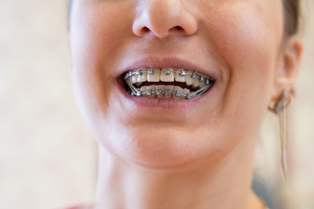 Close up of a womans smile with braces on her teethの写真素材