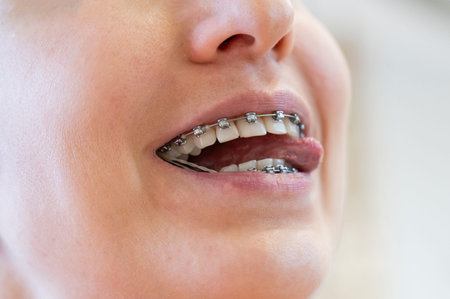 Close up of a womans smile with braces on her teeth