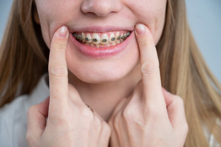 Close-up of a young womans smile with metal braces on her teeth. Correction of bite.の写真素材