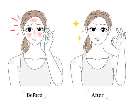 Illustration of a woman taking care of her skin. She is touching her skin with her hand on her cheek. A woman wearing a tank top suffering from sunburn. White background. Before and after the skin recovers.のイラスト素材
