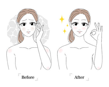 Illustration of a woman taking care of her skin. She is touching her skin with her hand on her cheek. A woman suffering from dry skin. White background. Before and after the skin recovers.のイラスト素材