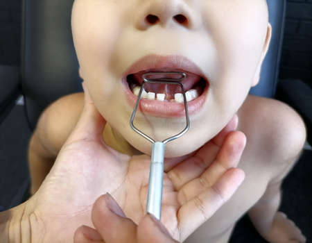 The boy's tongue in the classroom with a speech therapist performs exercises. dyslexia. Using special means of speech correction. Application of tools for speech triggering and correction.の写真素材