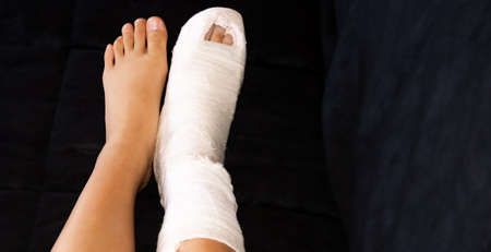 Legs of a young girl with a broken ankle in a cast and a white bandage on one leg.の写真素材