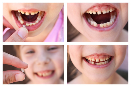 A collage of the child has lost the baby tooth. At 6 years old child loose tooth. The girl is holding the tooth in his hand. New molar tooth growing.の写真素材