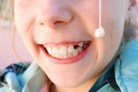 Child pulled out milk tooth with thread.
