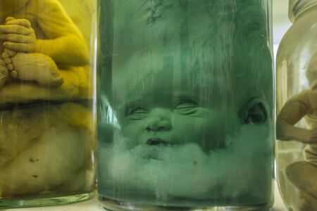 Hydrocephalus baby head in jar with formalin solutionの素材 [FY310130126758]