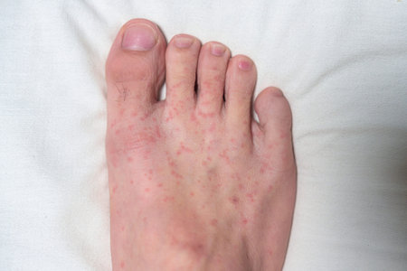 Allergic reaction, Red rash itychy on foot caused by weather or fungi