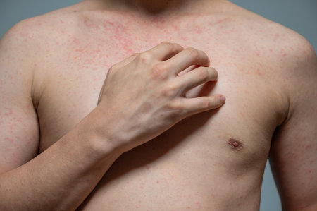 Dermatitis rash viral disease with immunodeficiency on body of young adult asian, scratching with itching, Measles Virus, Viral Exanthemの写真素材