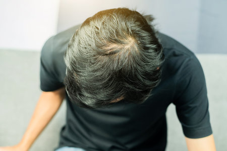 Men have problems with hair loss, thinning hair, baldness.