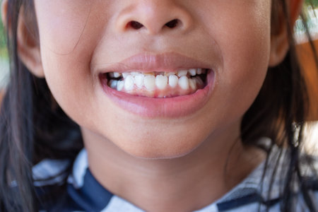 Stacked front tooth, a problem with children, parents should take to see the dentist.の写真素材