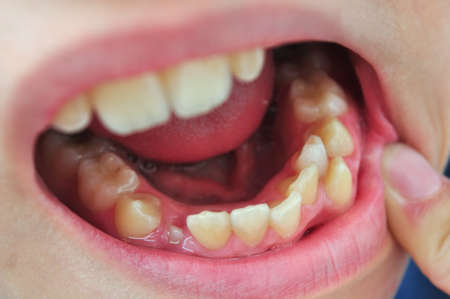 Malocclusion in the teeth of a child's mouth, incorrect teeth alignmentの写真素材