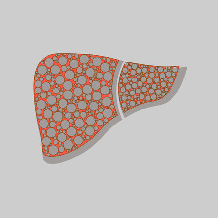  A healthy liver and a liver with cirrhosis. vector illustration.のイラスト素材