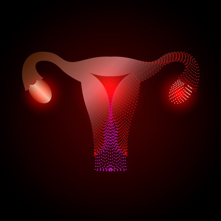 Uterus and ovaries with a point of pain. Stylized transition from a real organ to an X-ray effect. Medical illustration of diseases of the uterus and ovariesのイラスト素材