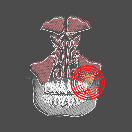 Odontogenic sinusitis. Inflammation of the maxillary sinuses due to a disease of the roots of the tooth with a point of pain and inflammation. 10 epsのイラスト素材