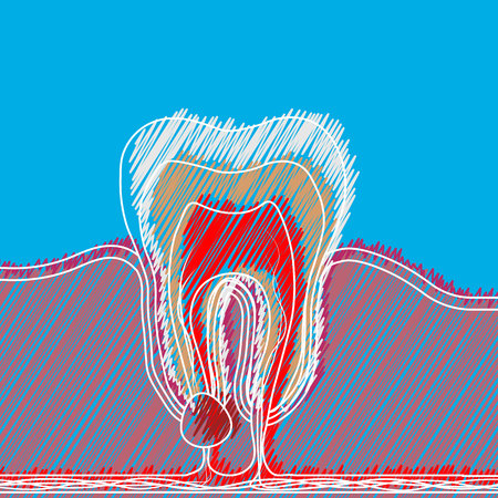 Stylized hatching of dental disease with a point of pain and inflammation. Medical illustration of tooth root inflammation, tooth root cyst, pulpitis. 10 epsのイラスト素材