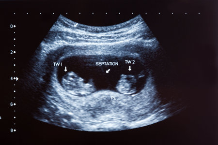 Ultrasound scan of 10 months old twin boys