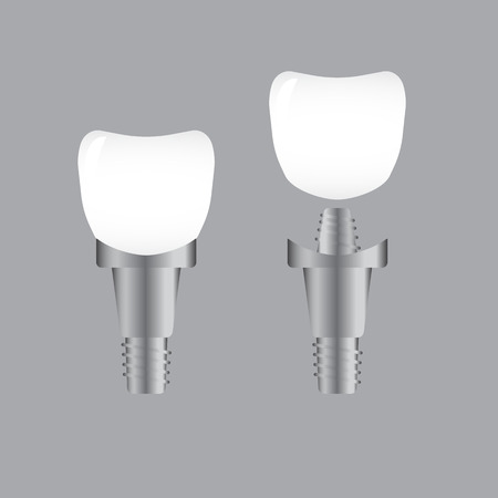 Tooth implant. Implant dental and health toothのイラスト素材