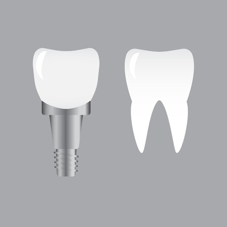 Tooth implants and normal tooth isolated on white background. Screw implant, dental inplant toothのイラスト素材