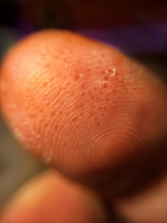 Pompholyx eczema Dyshidrosis, small blisters under the skinの写真素材
