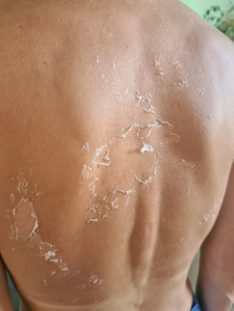 Closeup of peeling skin after sunburn in summer on back. sunburn and skin allergiesの写真素材