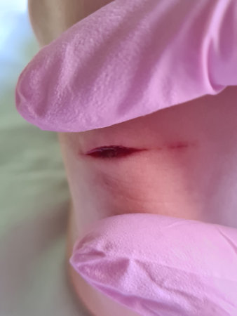 Children leg with heel and deep wound on doctor hand. deep skin cut concept