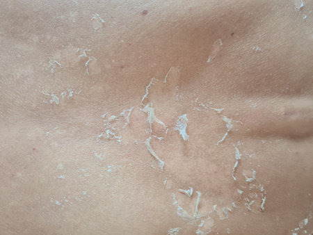 Tanned flaky back skin after sunburn conceptの写真素材