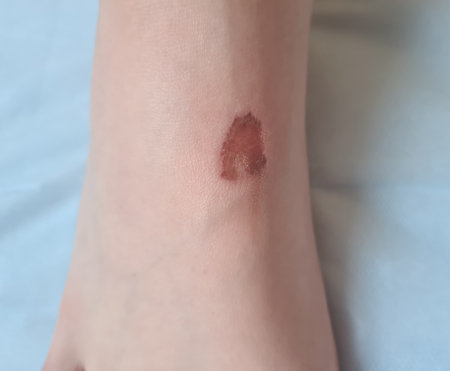 Children's foot with callus and wound or allergyの写真素材