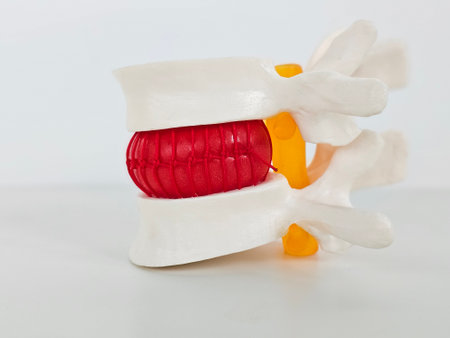 Model of human spine with inflamed intervertebral hernia. Intervertebral hernia symptoms and...