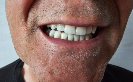 Close-up of a man showing healthy, bright teeth and facial hair in a neutral setting during daylight