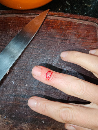 Hand injury with cut finger on a wooden cutting board next to a knife during food preparationの写真素材