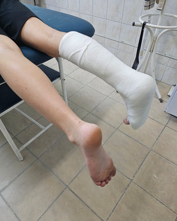 Injury treatment at clinic showing a leg with a cast and an uninjured foot on a hospital examination tableの写真素材