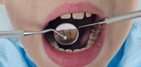 Closeup of a child's mouth during dental examination. Dental treatment for children and teenagers