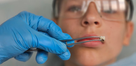 Dentist holds extracted tooth with caries with forceps. Child teeth are treatedの写真素材