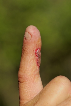 Flesh wound with blood on male fingerの写真素材