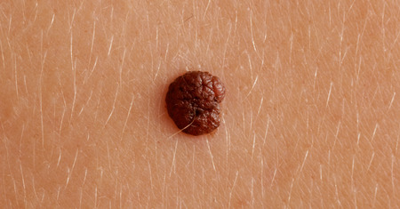 large dark mole on the caucasian skinの写真素材