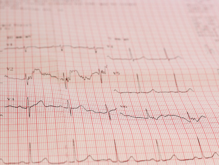 ecg graph, electrocardiogram ekg
