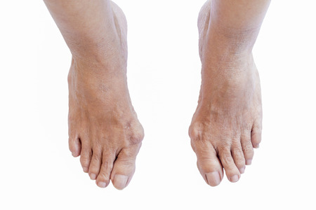 Hallux valgus, bunion in an old woman foot on white background