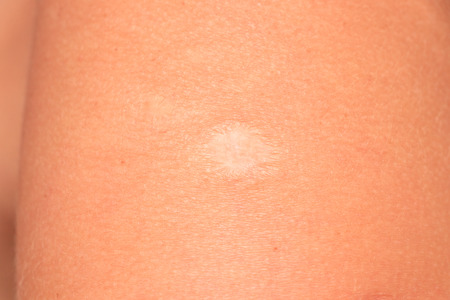 Vaccine scar on the skin
