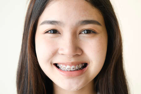 Face of a young woman with braces on her teethの写真素材