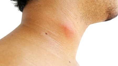 male injured with insect bite and sting