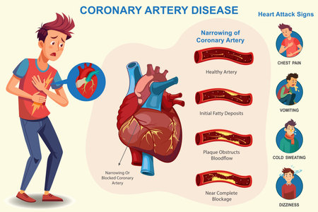Coronary artery disease which Narrowing of heart arteries, restricting blood flow, leading to heart attacks and chest pain, Which increases risk of heart attack.のイラスト素材