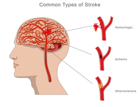Medical illustration of common types of Brain stroke, including ischemic, hemorrhagic, and transient ischemic attack, highlighting causes, effects, and differences for better understandingのイラスト素材