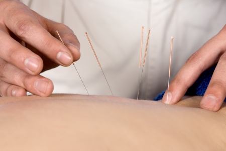 Adult male physiotherapist is doing acupuncture on the back of a female patient  Patient is lying down on a bed and is covered with royal blue towels の写真素材